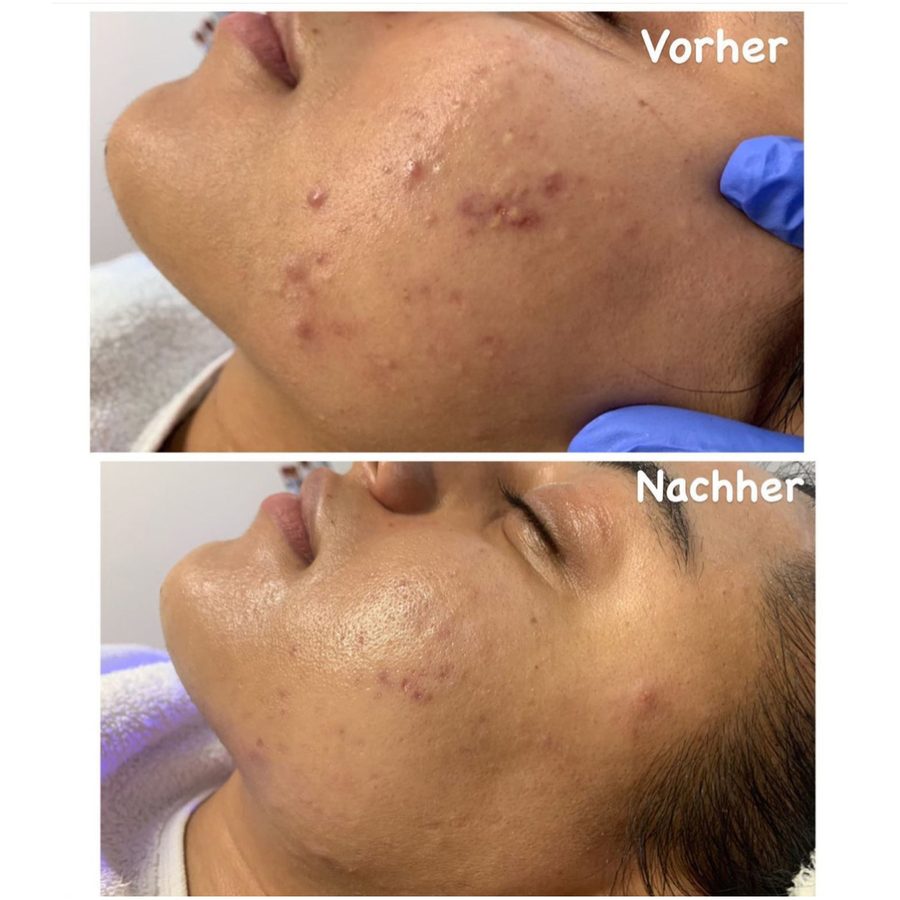 Vorher-nachher-Vergleich einer HydraFacial-Behandlung bei Akne