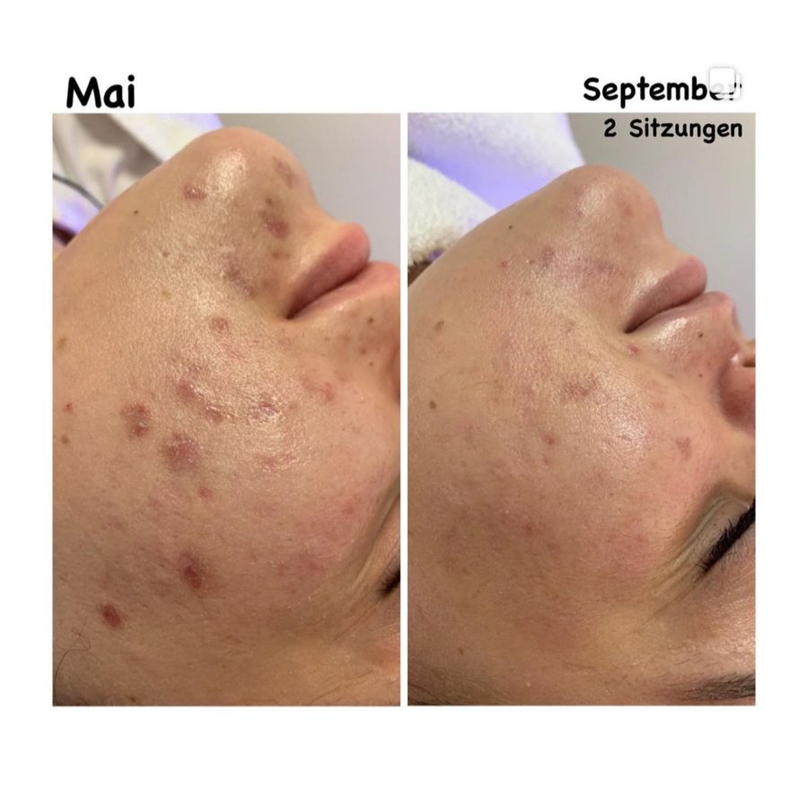Vorher-Nachher-Vergleich einer HydraFacial-Behandlung nach zwei Sitzungen