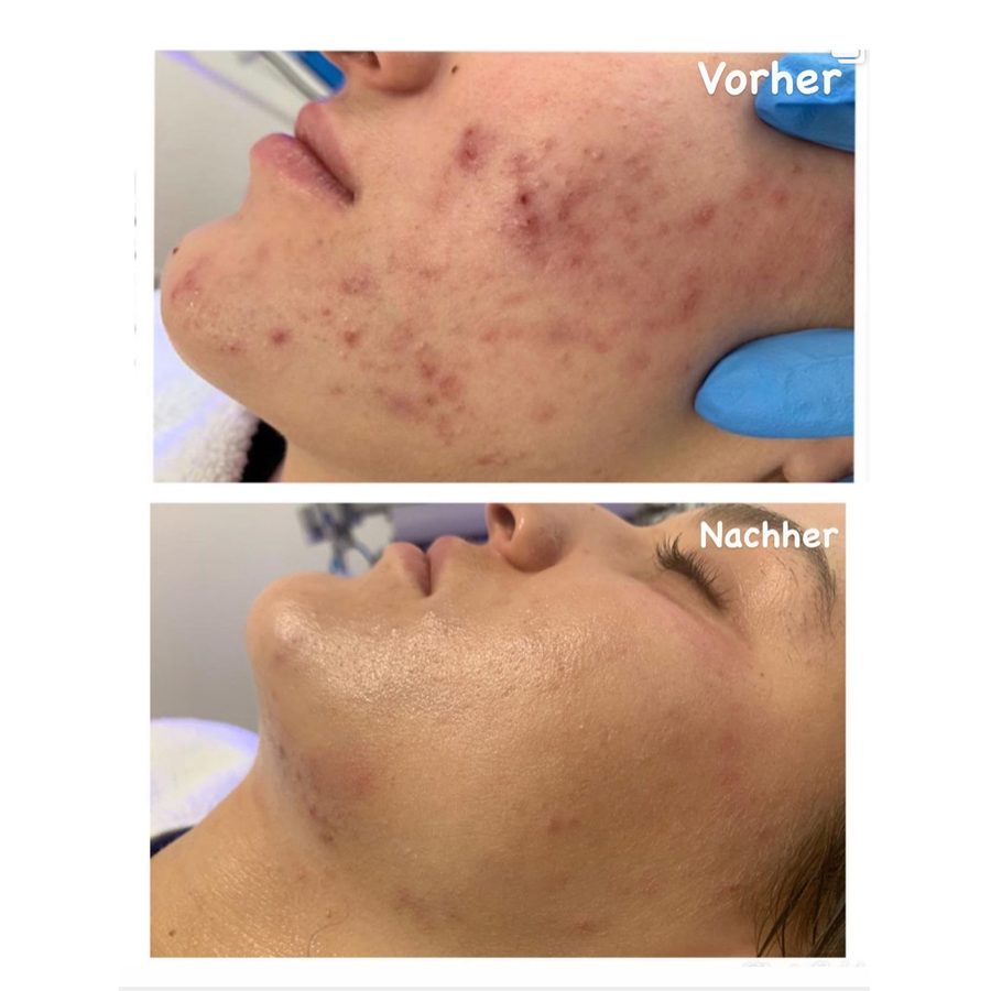 Vorher-Nachher-Vergleich einer HydraFacial-Behandlung an Kinn und Wange bei unreiner Haut
