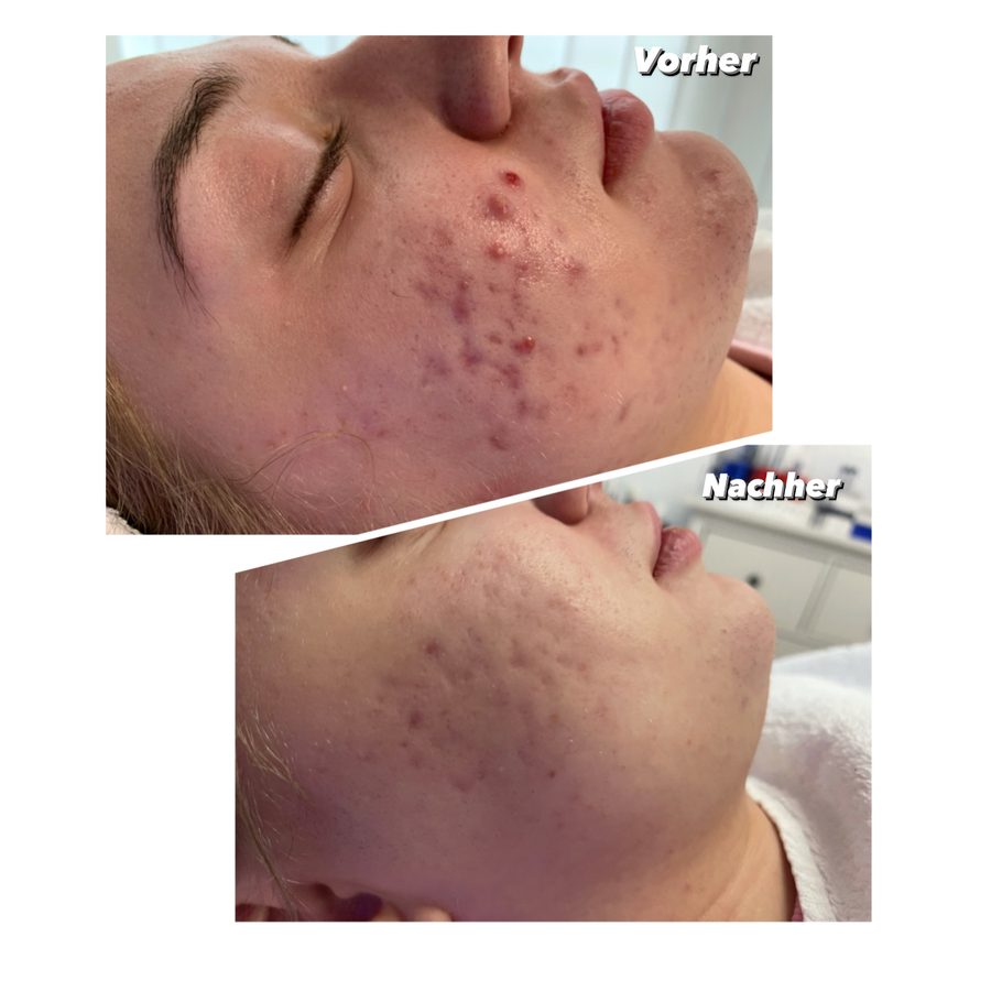 Vorher-Nachher-Vergleich einer HydraFacial-Behandlung am Kinn bei Unreinheiten