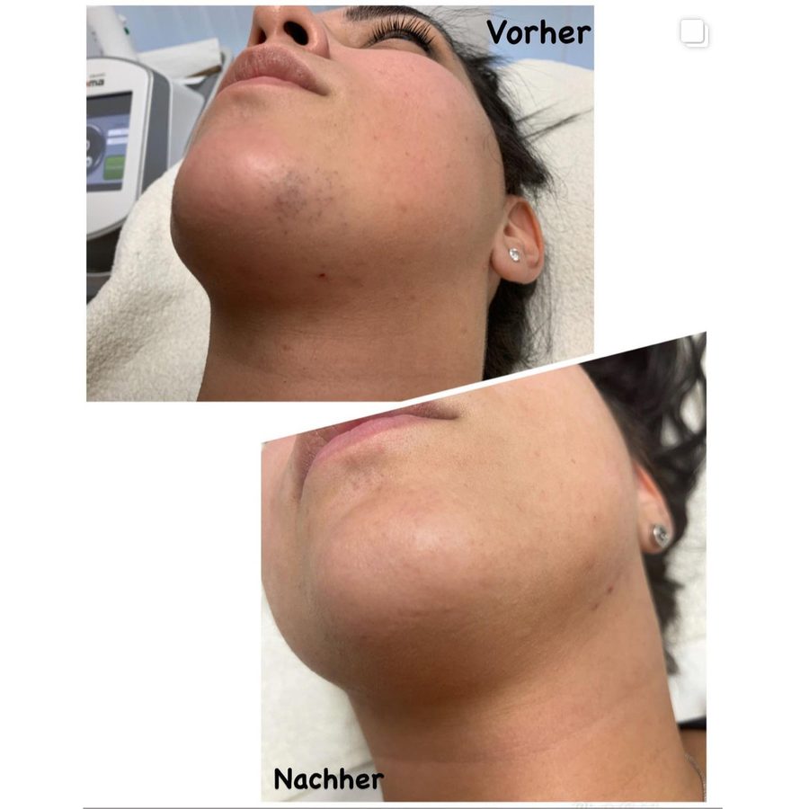 Vorher-nachher-Vergleich einer Laser-Haarentfernung am Kinn