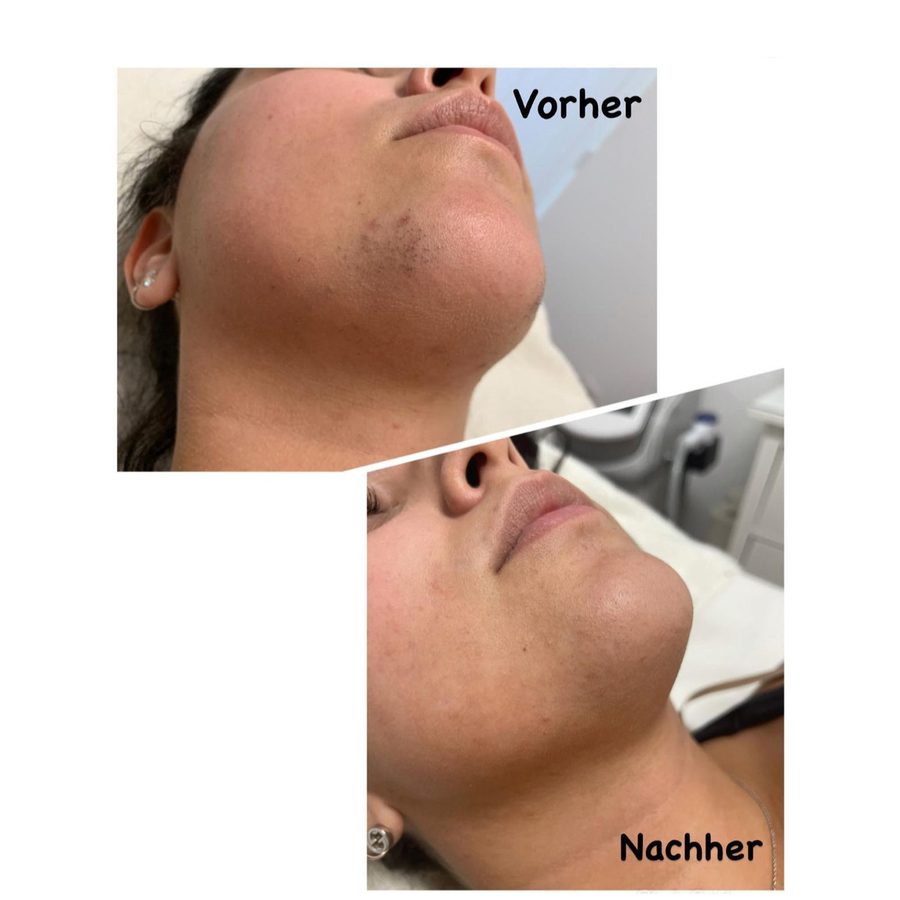 Vorher-nachher-Vergleich einer Laser-Haarentfernung