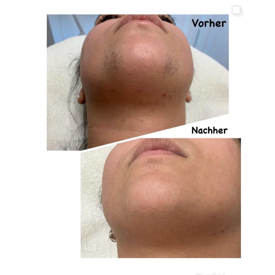 Vorher-nachher-Vergleich einer Laser-Haarentfernung