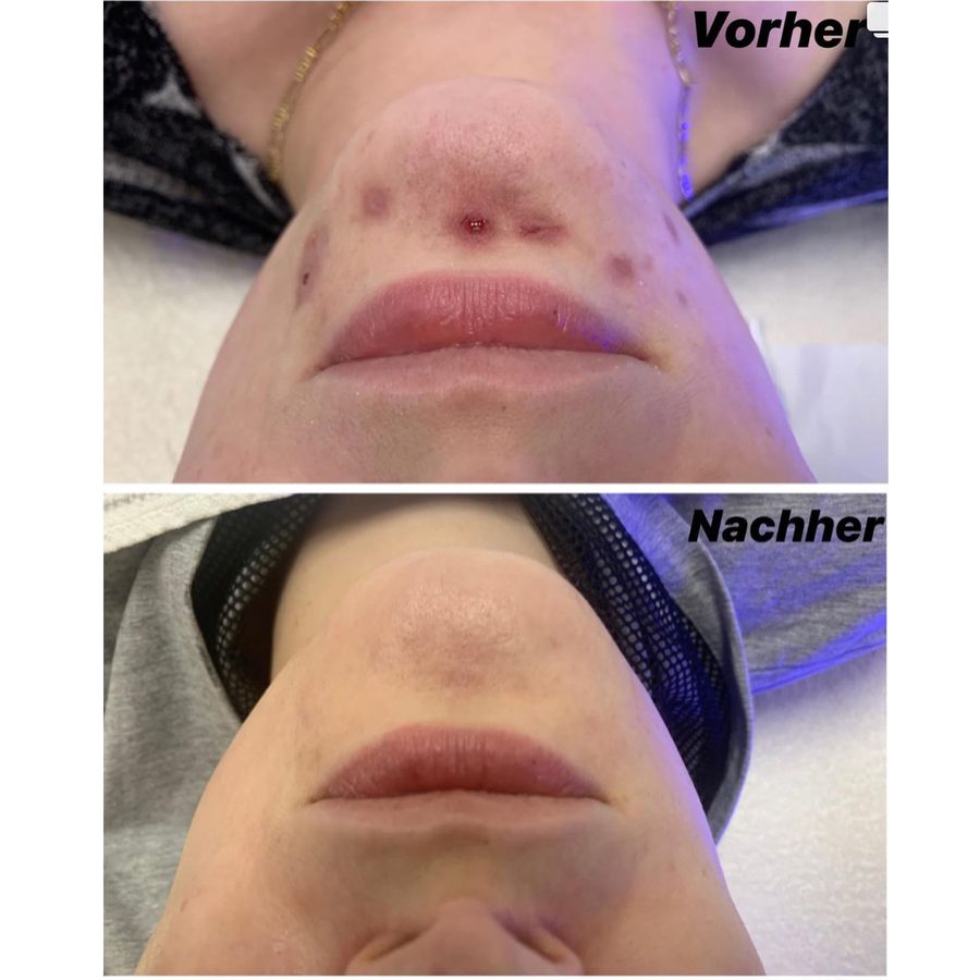 Vorher-nachher-Vergleich einer SkinPen-Microneedling-Behandlung an Kinn und Lippe