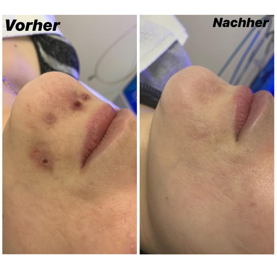 Vorher-Nachher-Vergleich einer SkinPen-Microneedling-Behandlung an der Wange