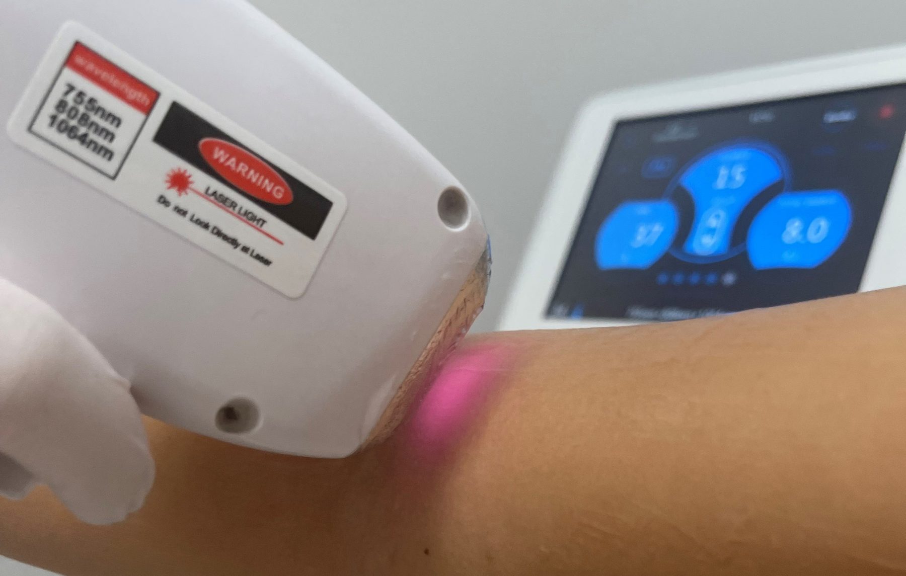 TITAN Laser-Handstück bei der Haarentfernung am Arm